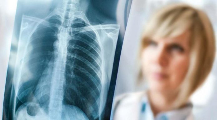 Tüdőszűrés lesz Röszkén