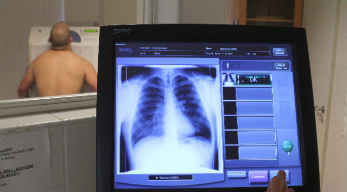 Tüdőszűrés Sándorfalván